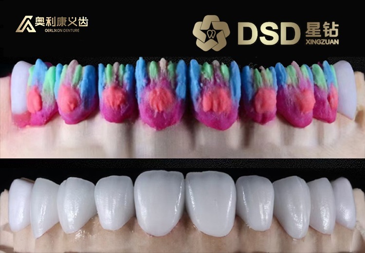 奥利康DSD星钻系列：专业美学修复流程，量身设计美牙方案，让你即刻拥有明星般笑容