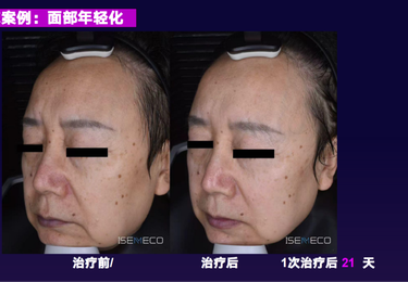 超声炮案例1