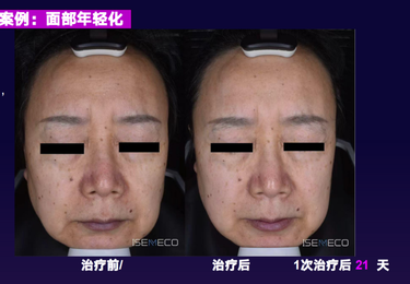 超声炮案例
