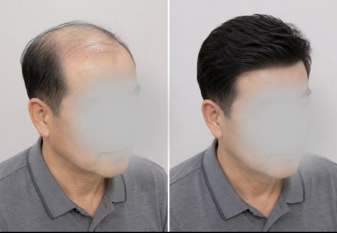 男士无痕发块定制