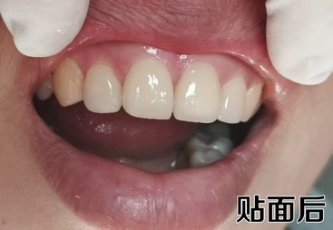 牙齿贴面