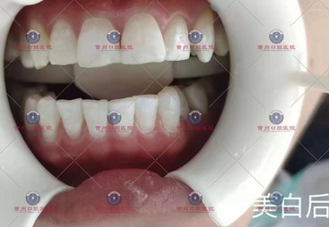 牙齿美白