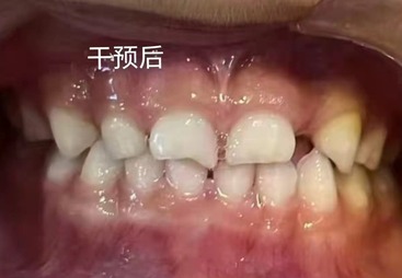 牙齿矫正