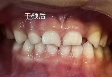 牙齿矫正