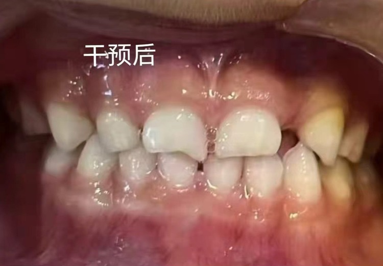 牙齿矫正