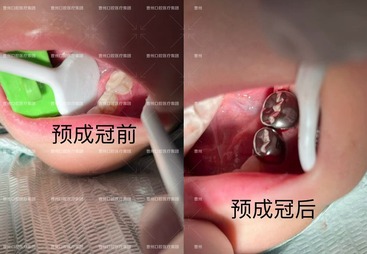 预成冠修复案例