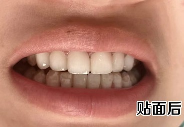 牙齿修复案例