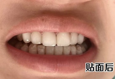 牙齿修复案例