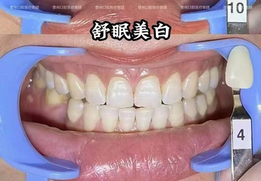 牙齿美白案例