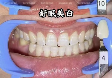 牙齿美白案例