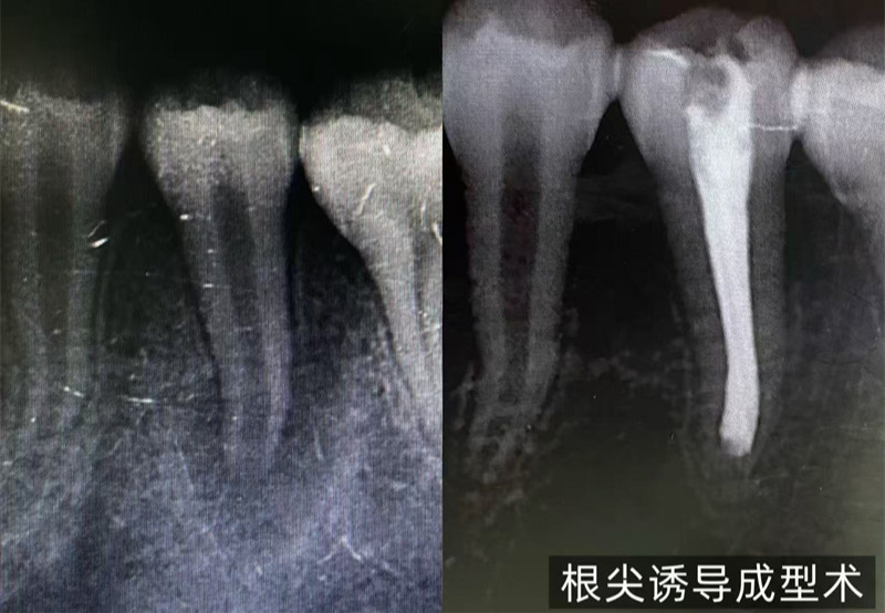 口内治疗